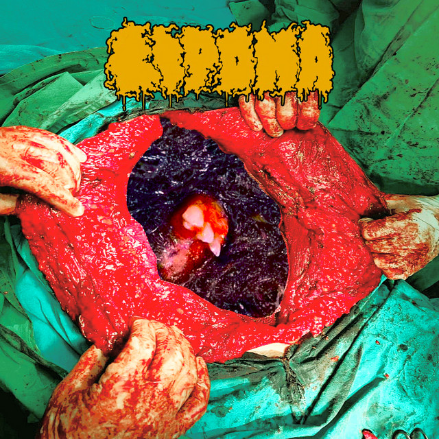 Lipoma