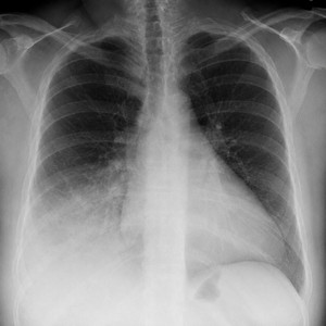 STXSTN — PNEUMONIA