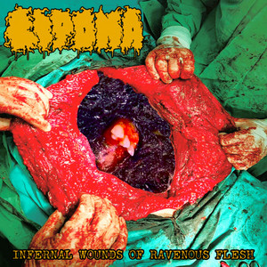 Crushed Beneath Anatomical Machinery by Lipoma