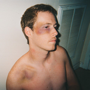 Bruises by Dylan Denton