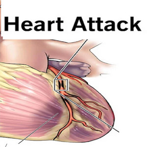 heart attack