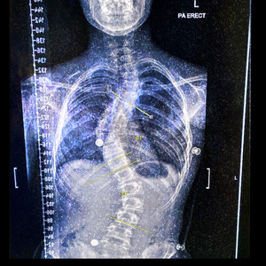 Tuberculosis by The Bandem