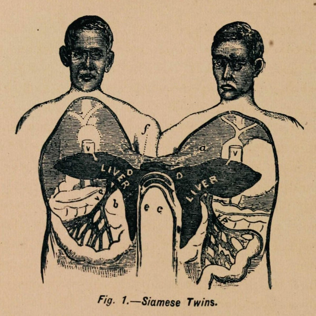 Siamese Twins cover art