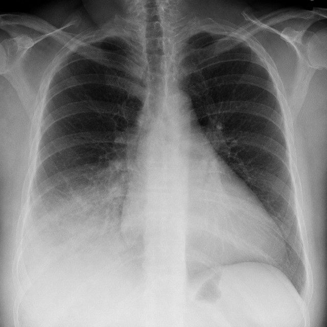 Обкладинка STXSTN — PNEUMONIA
