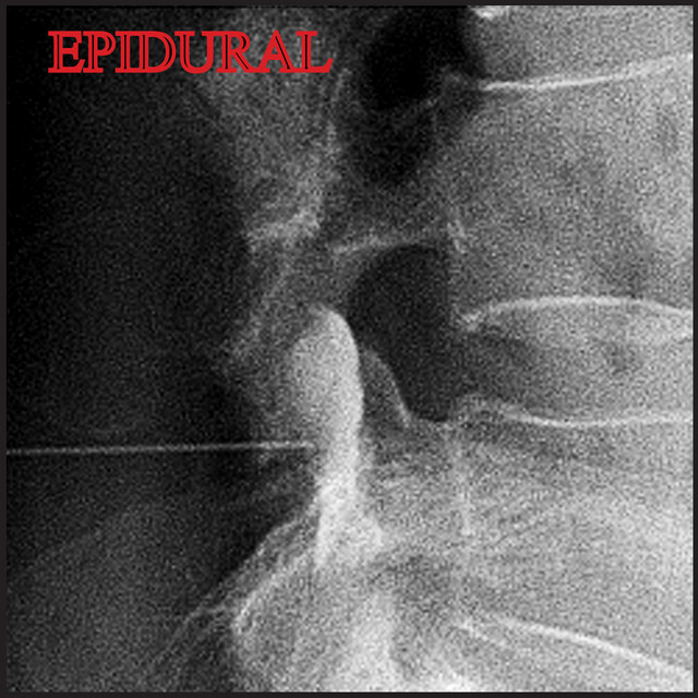 Epidural