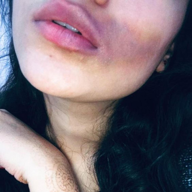 bruises cover art