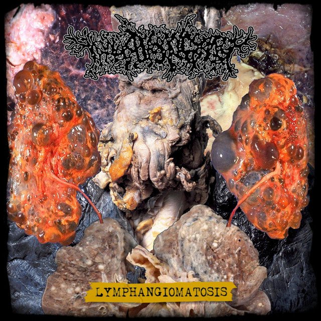 Lymphangiomatosis cover