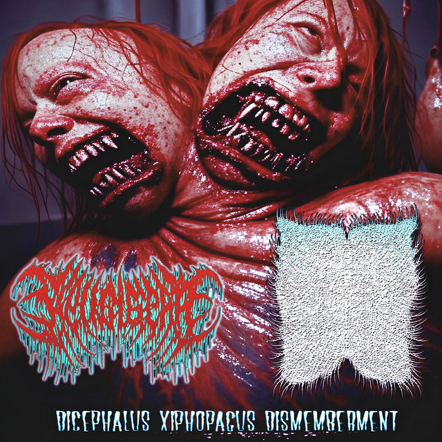 Dicephalus Xiphopagus Dismemberment