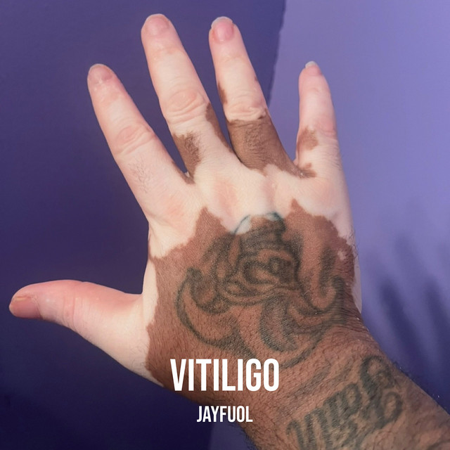 Vitiligo