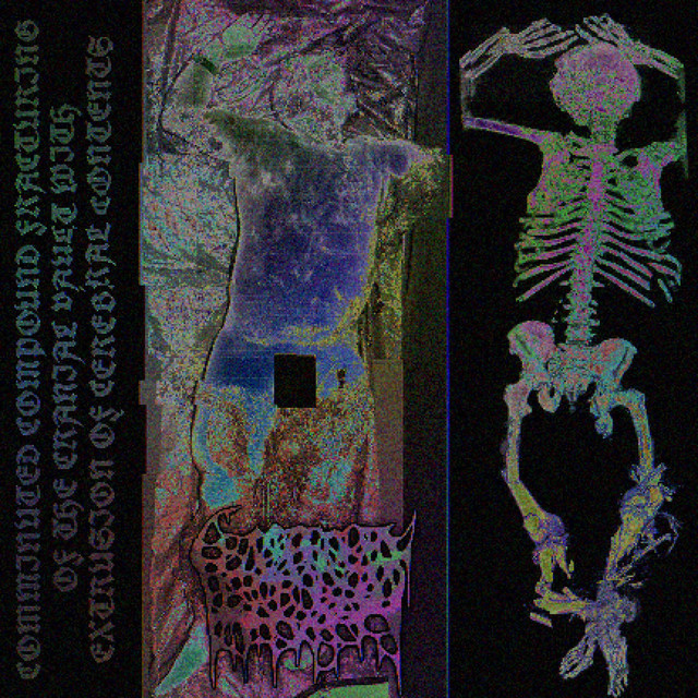 Comminuted Compound Fracturing of the Cranial Vault With Extrusion of Cerebral Contents cover art