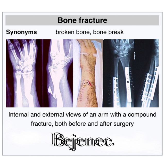 Bone Fracture cover art