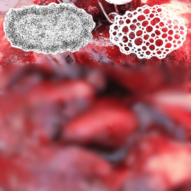 Split with Hydroencephalocystocele cover