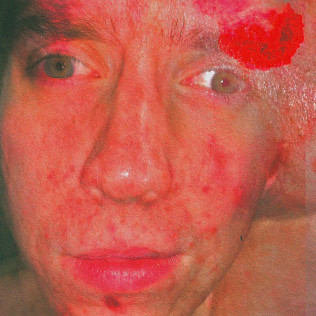 ACNE cover art